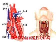 甲状腺功能减退性心肌病