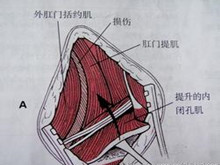 会阴疝