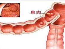 家族性结肠息肉