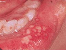 金属引起的口腔黏膜疾病
