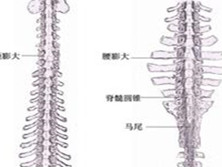脊髓分裂症