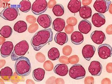 巨核细胞白血病