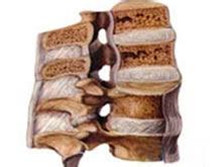 颈椎小关节创伤性退变性关节炎