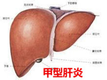 甲型肝炎