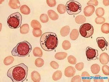 继发性铁粒幼细胞性贫血