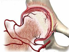 激素性股骨头坏死
