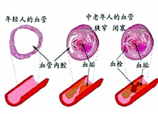 老年血栓性疾病