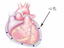老年恶性心包积液
