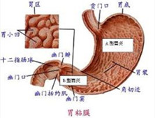 慢性糜烂性胃炎