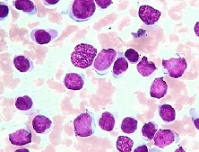 粒-单核细胞白血病