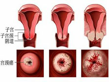 青少年及小儿子宫颈癌