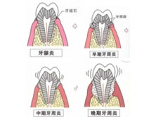 慢性根尖牙周炎