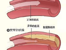 脑动脉硬化症