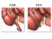 妊娠合并急性阑尾炎