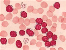 嗜酸性粒细胞白血病