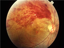 视网膜中央静脉阻塞