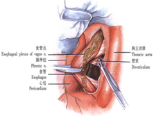 膈上食管憩室