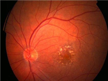 视网膜前膜