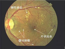 视网膜变性