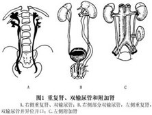 双重输尿管