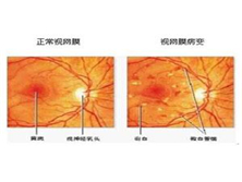视网膜血管病