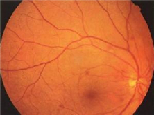 视网膜后膜