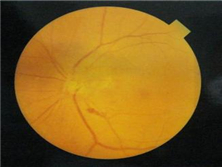 视网膜下新生血管膜