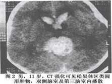 松果体区瘤