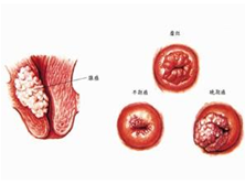 外阴恶性颗粒细胞瘤