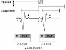 窦性期前收缩