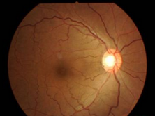 外层出血性视网膜病变