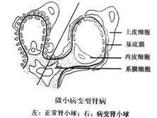 微小病变性肾病