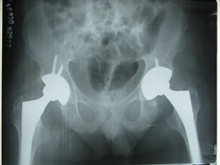 先天性髋关节外展挛缩和骨盆倾斜