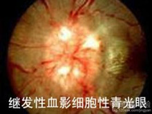 血影细胞性青光眼
