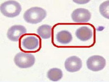 小儿遗传性球形红细胞增多症