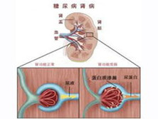 小儿糖尿病肾病