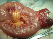 小肠血管瘤