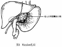 小网膜囊疝