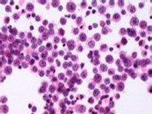 小儿铁粒幼红细胞性贫血