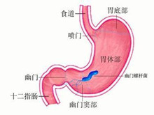 幽门螺杆菌感染