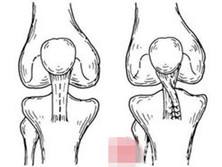 习惯性髌骨脱位