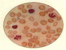 小儿巨幼细胞性贫血