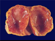 阴道血管肉瘤