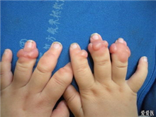 婴儿指趾纤维瘤病