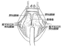 咽部瘢痕狭窄