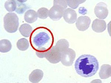 幼年型慢性粒细胞白血病