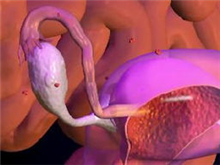 原发性卵巢类癌综合征