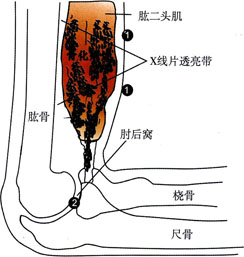 肘关节骨化肌炎