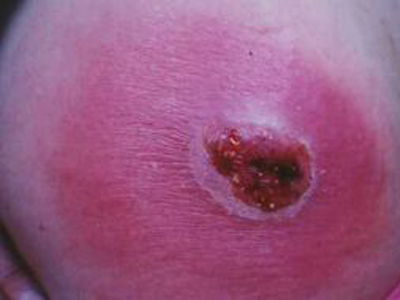 着色芽生菌病和暗色丝孢霉病