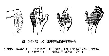 正中神经损伤